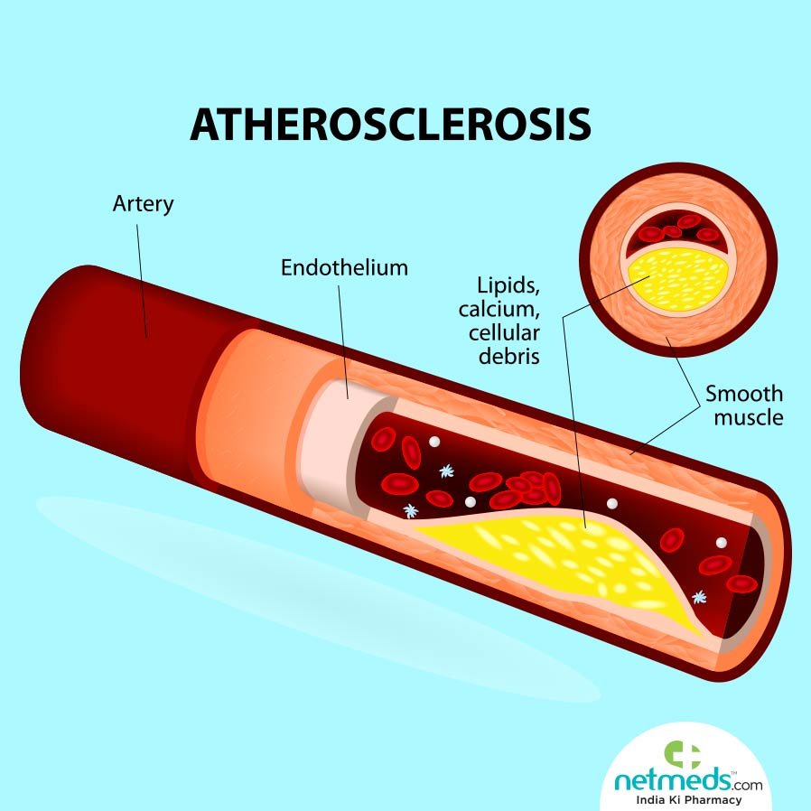 Atheroslcerosis