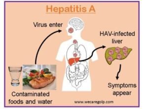 Hepatetis A