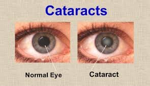 cataract