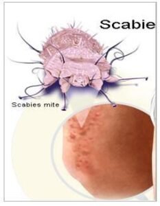 scabies