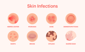 skin infections